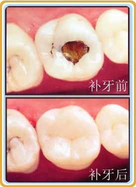 哪些方法对缓解蛀牙疼痛有好的效果